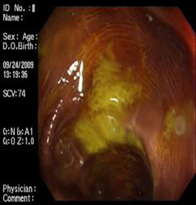 melanosis_coli_laxantes/mucosa_colonica_5