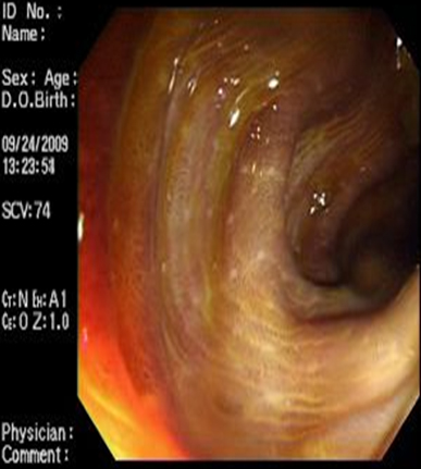 melanosis_coli_laxantes/mucosa_colonica_6 melanosis_coli_laxantes/mucosa_colonica_6