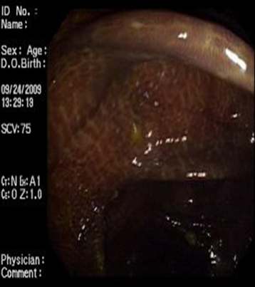 melanosis_coli_laxantes/mucosa_colonica_8