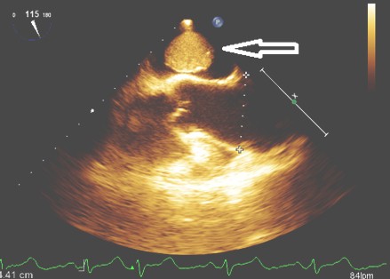 mixoma_auricular_caso/friable_pediculo_corto