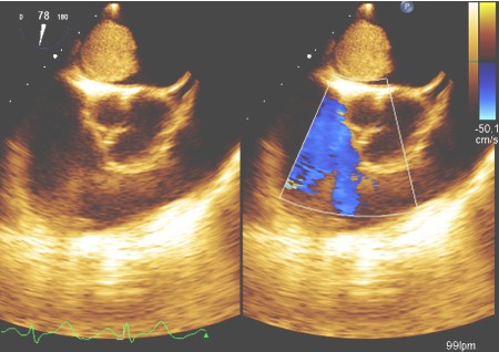 mixoma_auricular_caso/gradiente_diastolico_mitral