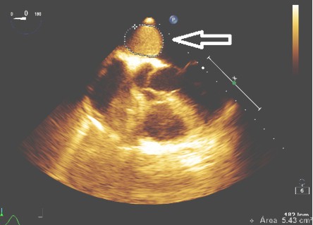 mixoma_auricular_caso/masa_tumoral_tabique