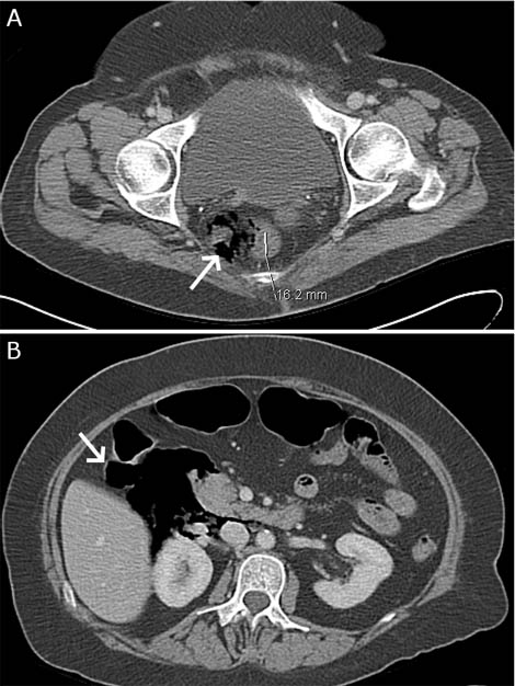 perforacion_rectal_colonoscopica/retroneumoperitoneo_perihepatico_presacro