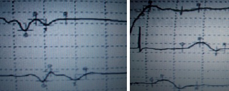 sindrome_Werdnig_Hoffmann/electromiografia_velocidad_conduccion sindrome_Werdnig_Hoffmann/electromiografia_velocidad_conduccion