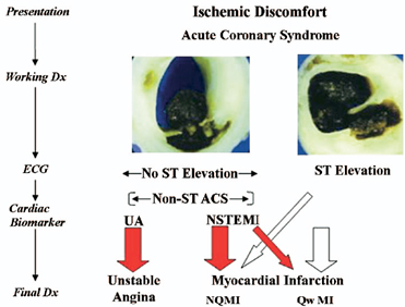 sindrome_coronario_agudo/clasificacion_sindromes_coronarios sindrome_coronario_agudo/clasificacion_sindromes_coronarios