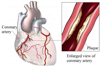 sindrome_coronario_agudo/proceso_ateroesclerosis_coronaria sindrome_coronario_agudo/proceso_ateroesclerosis_coronaria