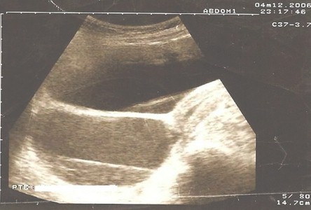 himen_imperforado_sordera/cavidad_vaginal_dilatada himen_imperforado_sordera/cavidad_vaginal_dilatada