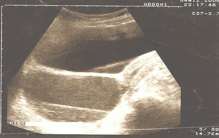 himen_imperforado_sordera/ecografia_engrosamiento_endometrial himen_imperforado_sordera/ecografia_engrosamiento_endometrial