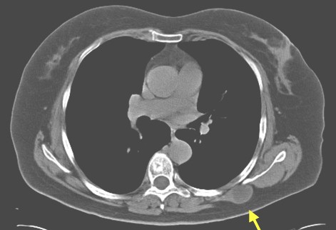 mixoma_intramuscular_subescapular/TAC_toracico_tumor