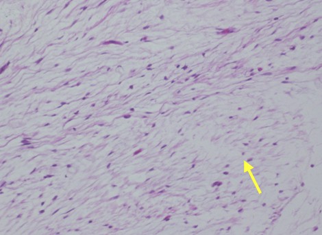 mixoma_intramuscular_subescapular/histologia_anatomia_patologica