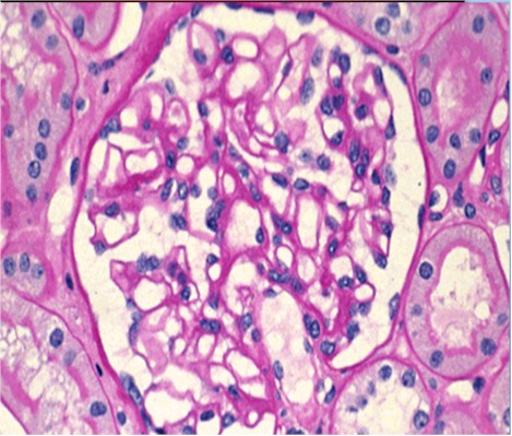 utilidad_biopsia_renal/imagen_renal_1