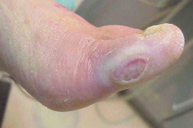 autoanalisis_glucemico_control/ulcera_varicosa_diabetica autoanalisis_glucemico_control/ulcera_varicosa_diabetica