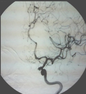 aneurisma_perioftalmico_postraumatico/arteriografia_cerebral_angiografia aneurisma_perioftalmico_postraumatico/arteriografia_cerebral_angiografia