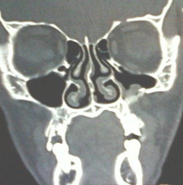 aneurisma_perioftalmico_postraumatico/tomografia_senos_paranasales