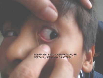 conjuntivitis_alergica_infantil/edema_saco_conjuntival