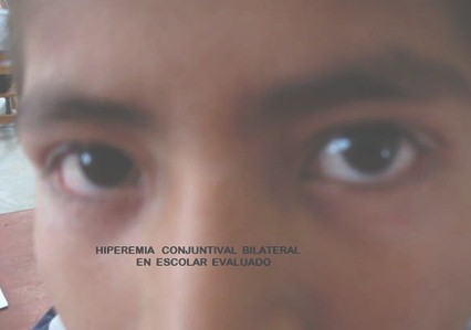 conjuntivitis_alergica_infantil/hiperemia_conjuntival_bilateral