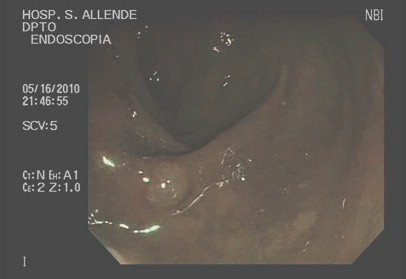 cromoendoscopia_colon_lesiones/colonoscopia_digestiva_NBI cromoendoscopia_colon_lesiones/colonoscopia_digestiva_NBI