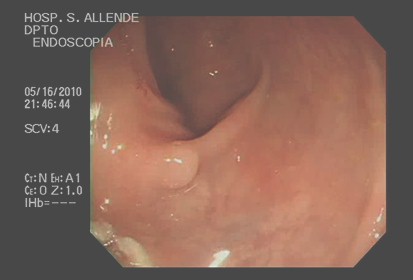 cromoendoscopia_colon_lesiones/colonoscopia_digestiva_convencional