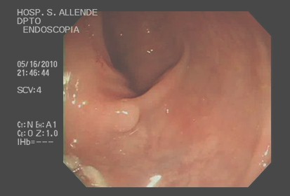 cromoendoscopia_colon_lesiones/colonoscopia_digestiva_convencional cromoendoscopia_colon_lesiones/colonoscopia_digestiva_convencional
