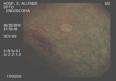 cromoendoscopia_colon_lesiones/lesion_plana_colon cromoendoscopia_colon_lesiones/lesion_plana_colon