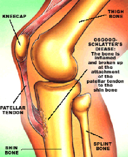 lesiones_futbol_infancia/Enfermedad_Osgood_Schlatter