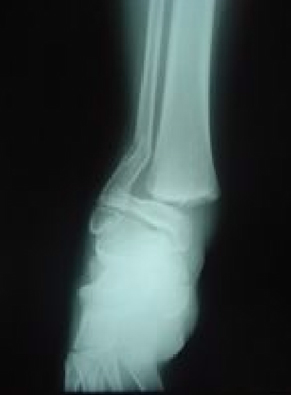 lesiones_futbol_infancia/Fractura_tobillo_infancia lesiones_futbol_infancia/Fractura_tobillo_infancia