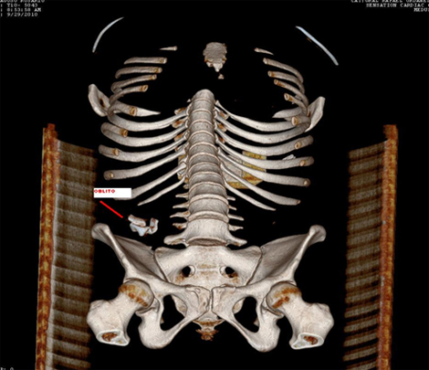 recopilacion_casos_oblitos/Cesarea_TAC_abdominal