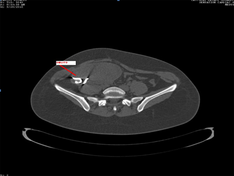 recopilacion_casos_oblitos/Cesarea_TAC_mesogastrio