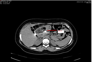 recopilacion_casos_oblitos/Paciente_femenino_metalico recopilacion_casos_oblitos/Paciente_femenino_metalico