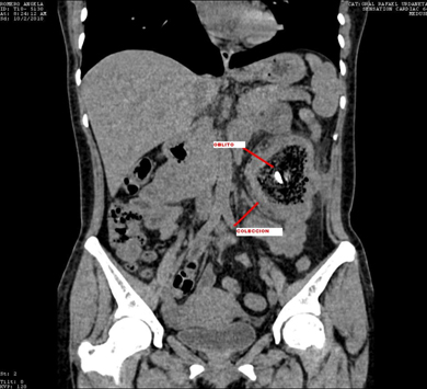 recopilacion_casos_oblitos/TAC_abdominal_acintada