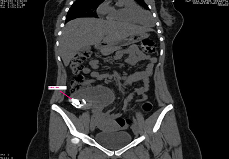 recopilacion_casos_oblitos/TAC_abdominal_mesogastrio