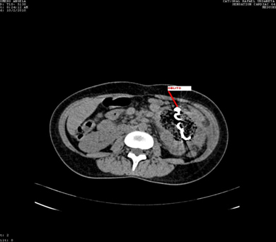 recopilacion_casos_oblitos/TAC_abdominal_metalica