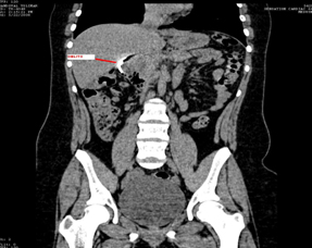 recopilacion_casos_oblitos/femenino_metalico_abdomen recopilacion_casos_oblitos/femenino_metalico_abdomen