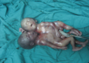 siameses_toracopagos_caso/toracopago_1 siameses_toracopagos_caso/toracopago_1