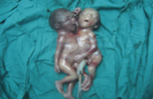 siameses_toracopagos_caso/toracopago_2 siameses_toracopagos_caso/toracopago_2