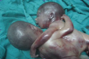 siameses_toracopagos_caso/toracopago_3 siameses_toracopagos_caso/toracopago_3