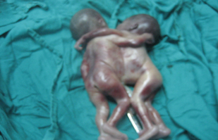 siameses_toracopagos_caso/toracopago_4 siameses_toracopagos_caso/toracopago_4