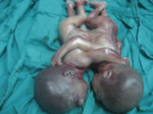 siameses_toracopagos_caso/toracopago_6 siameses_toracopagos_caso/toracopago_6
