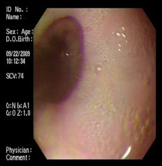 acalasia_asociada_embarazo/estenosis_benigna_puntiforme