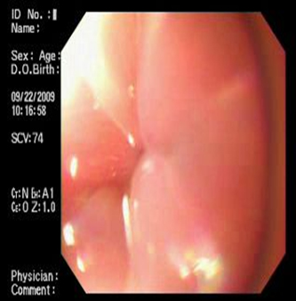 acalasia_asociada_embarazo/estenosis_puntiforme_concentrica