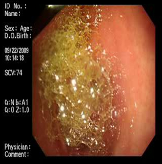 acalasia_asociada_embarazo/lesiones_eritematosas_reflujo