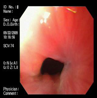 acalasia_asociada_embarazo/mejoria_estenosis_esofagica