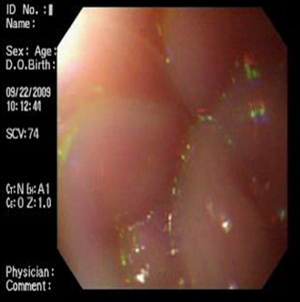 acalasia_asociada_embarazo/pliegues_estenosis_contraccion