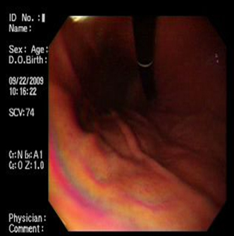 acalasia_asociada_embarazo/retroversion_cuerpo_eritematosas