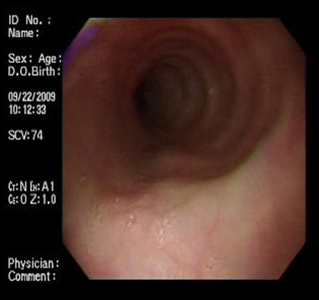 acalasia_asociada_embarazo/rosada_dilatacion_esofagica