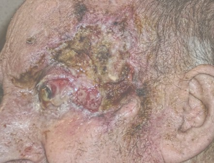 carcinoma_basocelular_caso/clinico_tumores_cutaneos carcinoma_basocelular_caso/clinico_tumores_cutaneos
