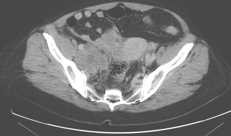 carcinoma_microcitico_vejiga/ganglios_adenopatias_iliacas