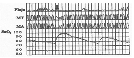 cuidados_enfermeria_apnea/electrosomnomiograma_estudio_saturacion cuidados_enfermeria_apnea/electrosomnomiograma_estudio_saturacion