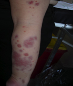 edema_hemorragico_agudo/lesiones_eritemato_violaceas edema_hemorragico_agudo/lesiones_eritemato_violaceas