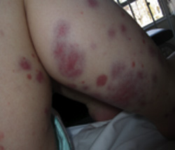 edema_hemorragico_agudo/lesiones_eritemato_violaceas_EHAI edema_hemorragico_agudo/lesiones_eritemato_violaceas_EHAI